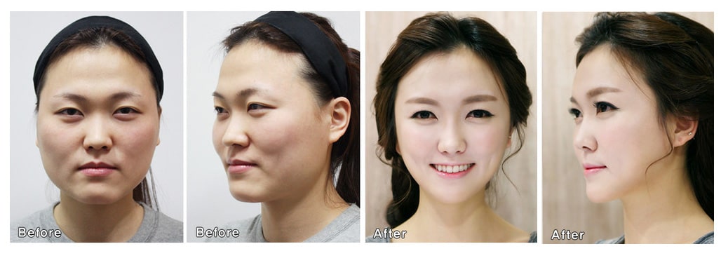 عکس قبل و بعد از جراحی پلاستیک